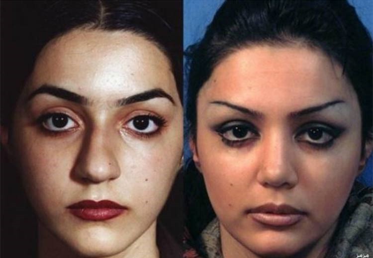 بالصور.. إيران عاصمة عمليات تجميل الأنف في العالم