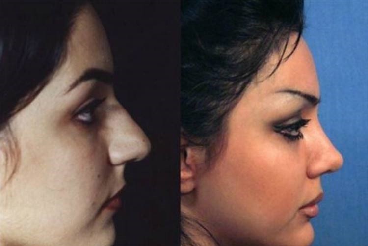 بالصور.. إيران عاصمة عمليات تجميل الأنف في العالم