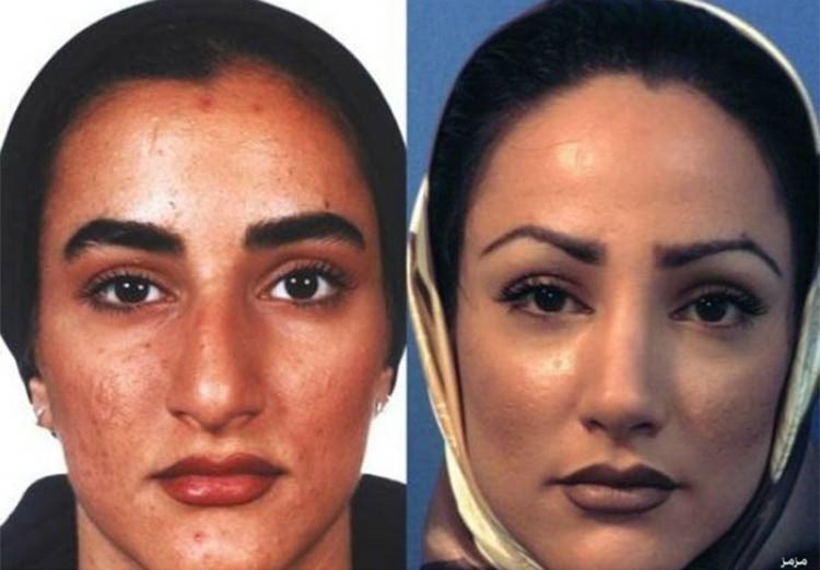 بالصور.. إيران عاصمة عمليات تجميل الأنف في العالم