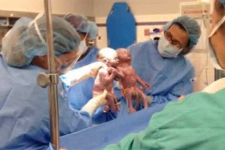 بالفيديو.. لقطة نادرة.. أميركية تضع طفلتين تمسكان بيد بعضهما لحظة الولادة