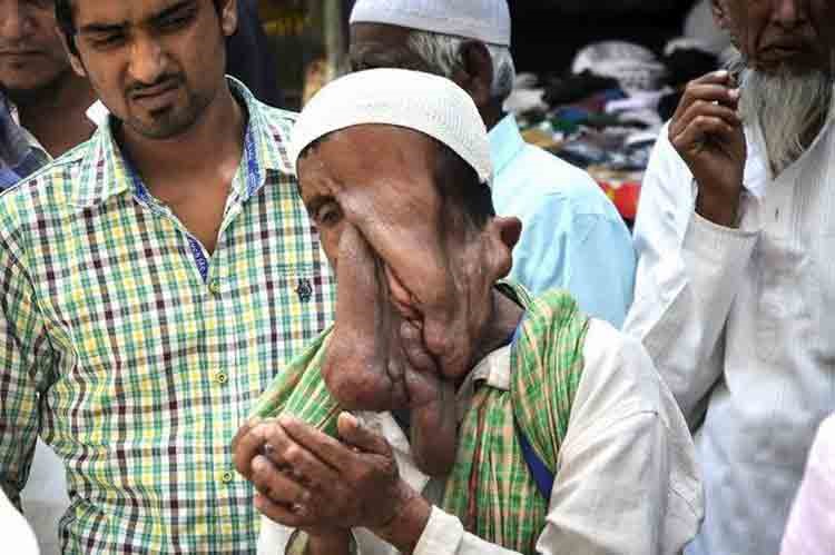 بالصور.. «الرجل المنصهر» يرفض إعانة لإصلاح تشوهات خطيرة بوجهه ليتسول 