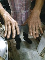 سوء نظافة