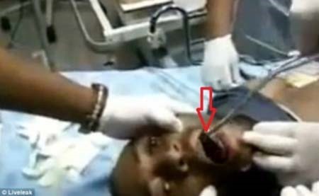 بالفيديو.. إنقاذ شاب أفريقي ( بلع ) هاتفه "الايفون" وكاد يفقد حياته