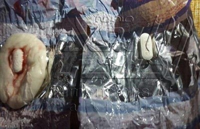 بالصور... سعودي يُفاجَأ بحبوب مخدرة داخل قرقيعان كويتية تسببت بإعياء طفلته