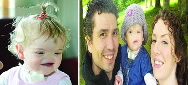 صورة: طفلة مولودة بلا أنف .. تعيش حياة طبيعية