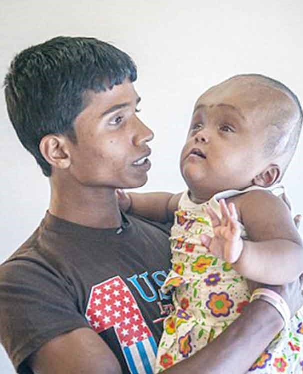 بالصور.. إنقاذ طفلة هندية بـ "تقليص" حجم رأسها ! 