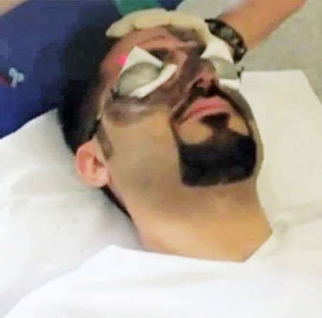 نواف اثناء ازالة الكربون من على بشرته