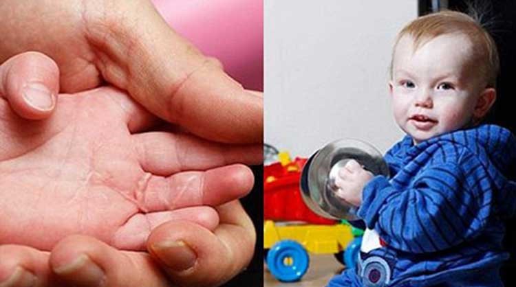 بالصور .. رضيع يتعرض لعضة ثعلب تسلل لغرفة نومه 