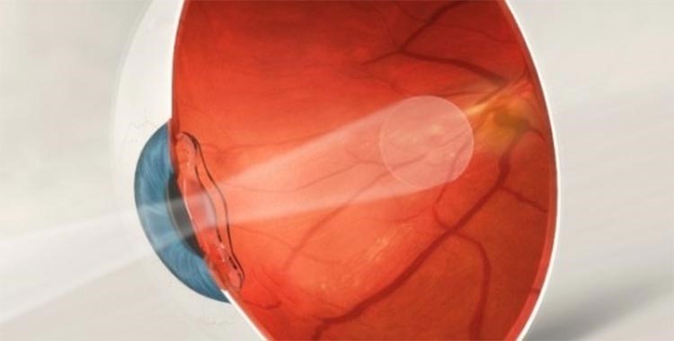 بالصور.. طبيب بريطاني يخترع تقنية ثورية لعلاج ضعف البصر 