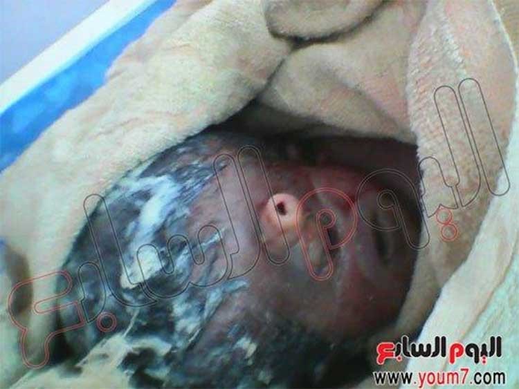 بالصور.. ولادة طفل بعين واحدة وأنف مسمار في مصر