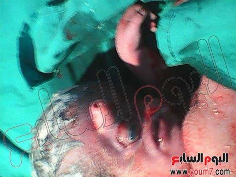 بالصور.. ولادة طفل بعين واحدة وأنف مسمار في مصر