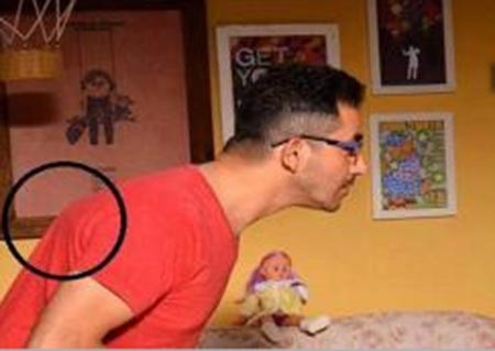 نشطاء يتداولون صورة لورم في ظهر أحمد حلمي