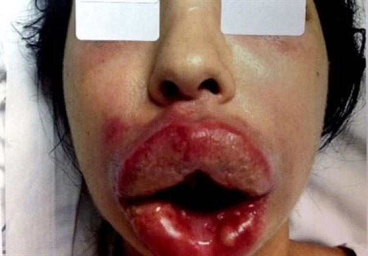 فيديو وصور صادمة لعمليات تجميل فاشلة في لبنان وفضحها وزير الصحة اللبناني