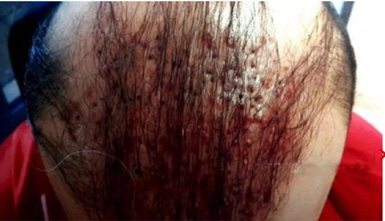 فيديو وصور صادمة لعمليات تجميل فاشلة في لبنان وفضحها وزير الصحة اللبناني