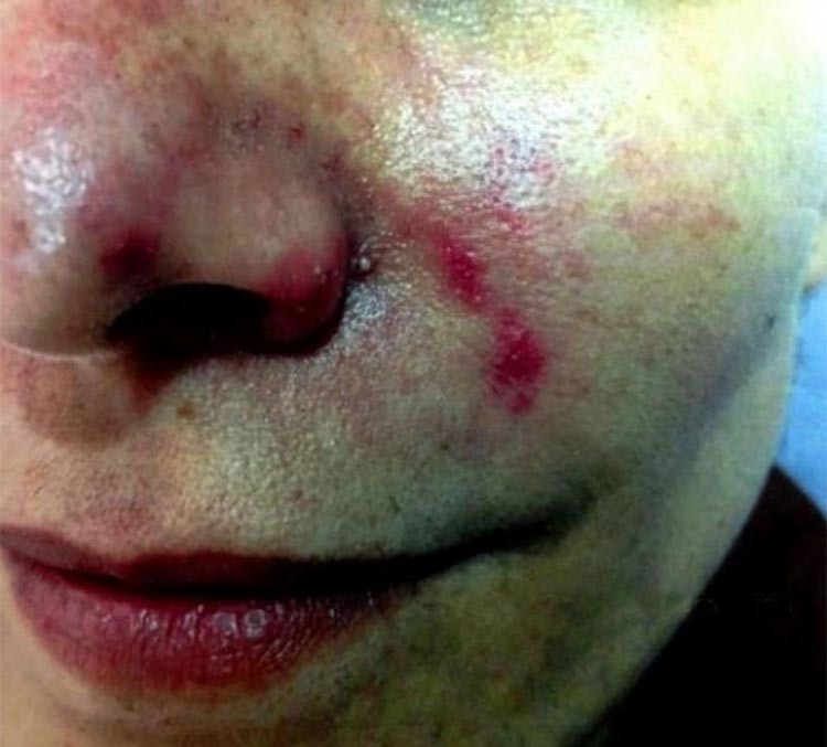 فيديو وصور صادمة لعمليات تجميل فاشلة في لبنان وفضحها وزير الصحة اللبناني