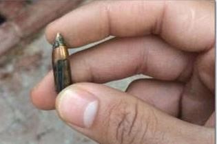 الطلقة بعد استخراجها من قدم المراة﻿