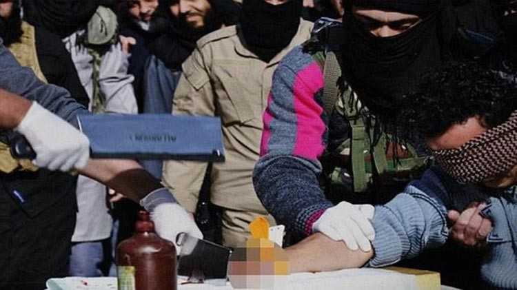 عملية قطع يد متهم بالسرقة
