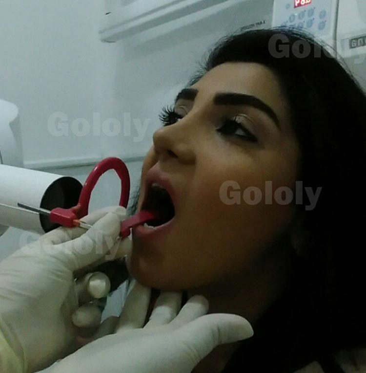  بالفيديو والصور.. شهد الياسين تصور عملية حشو ضرسها بدون بنج! 