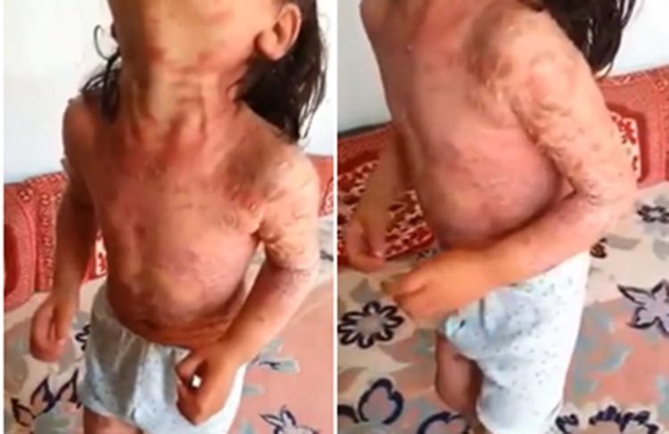 بالفيديو.. خادمة تحرق طفلة بالزيت المغلي وجلدها المشوه يثير التساؤلات