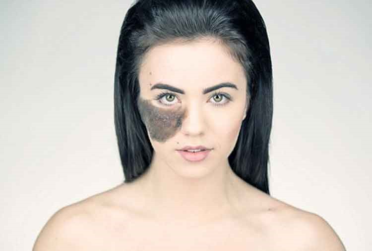بالصور.. راقصة استعراضية تتباهى بعاهتها وترفض التجميل