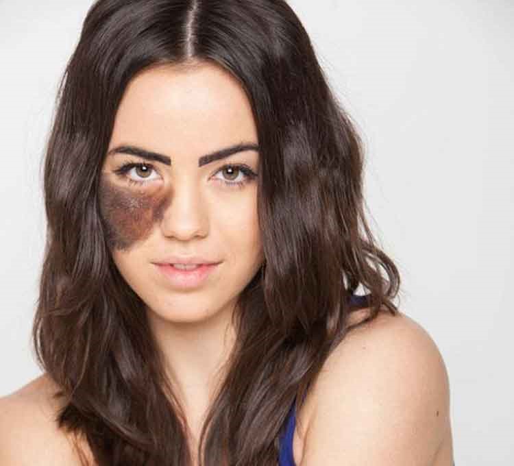 بالصور.. راقصة استعراضية تتباهى بعاهتها وترفض التجميل