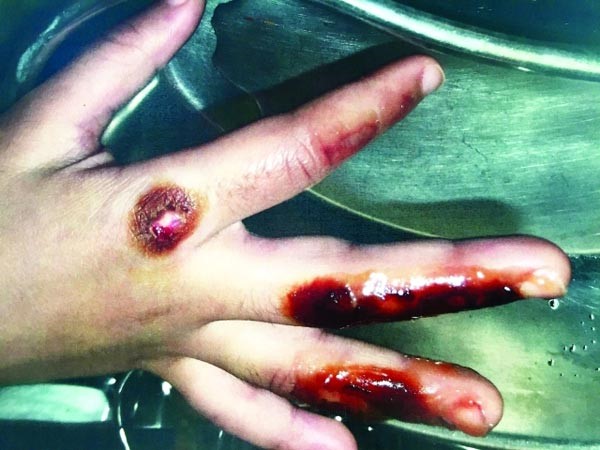 إيداع 4 شقيقات «دبي للرعاية» بعد إقدام زوجة الأب على حرق يد إحداهن