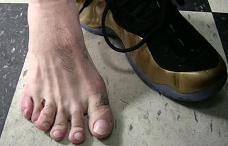صورة للقدم ذات الاصابع الستة