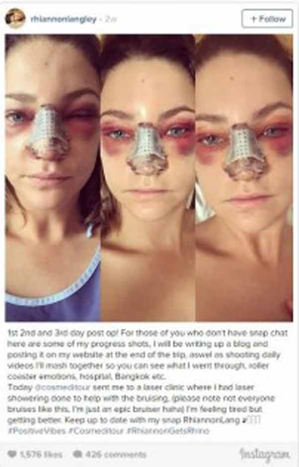 بالصور.. حسناء أسترالية تقارن بين وجهها قبل وبعد جراحة التجميل