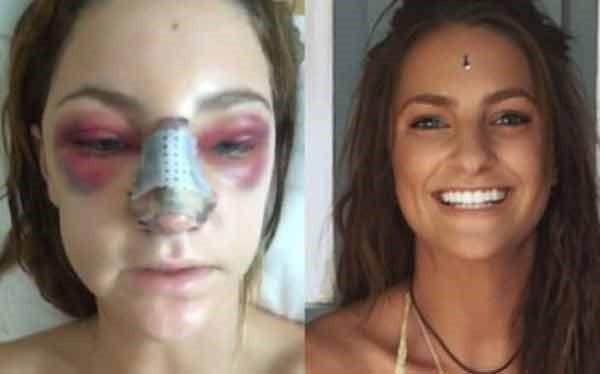 بالصور.. حسناء أسترالية تقارن بين وجهها قبل وبعد جراحة التجميل