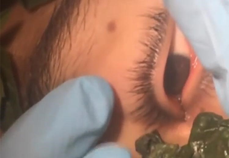 بالفيديو.. طبيبة تخرج دودة من عين مراهق بيروفي عاشت في عينه لأكثر من شهر