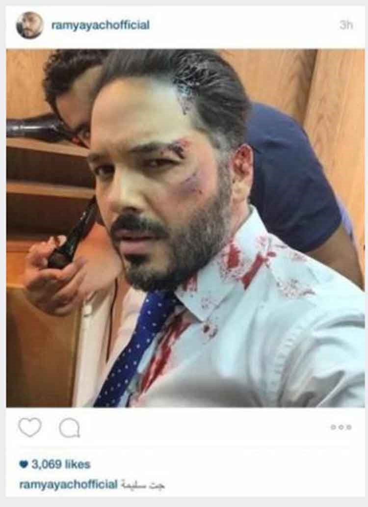 بالصور.. رامى عياش يتعرض لضرب مبرح يسيل الدماء من وجهه بسبب فتاة في الشارع ويؤكد: جت سليمة!