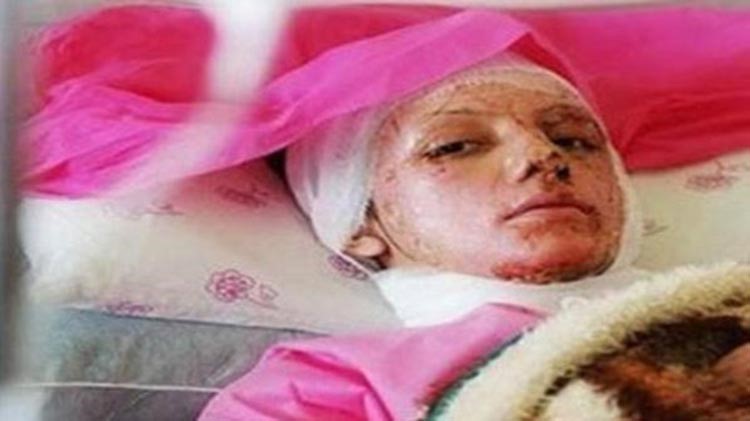 إيران.. القبض على متهم بقضية حرق النساء بالأسيد