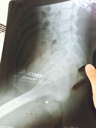 صورة اشعة توضح مكان الرصاصات في ظهر الاسيوي﻿