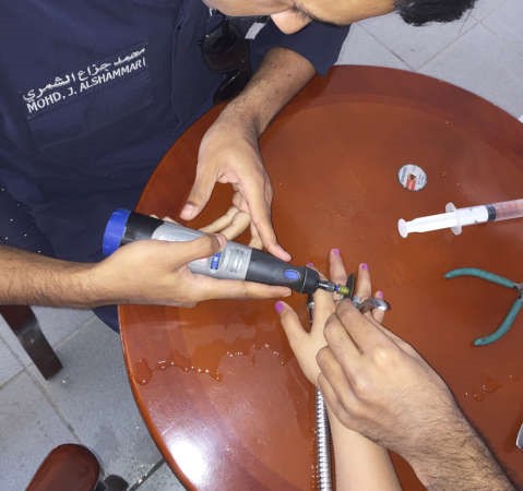 خلال عملية قص الحلقة عن اصبع الطفلة