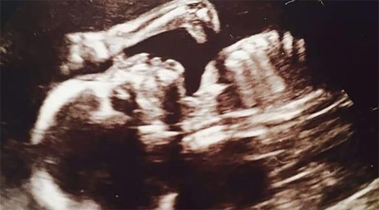 صورة للجنين بجهاز الموجات فوق الصوتية