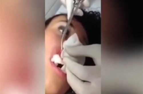 بالفيديو.. إزالة يرقة حية من داخل شفة امرأة
