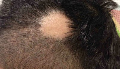 صورة تم تحميلها لمريض بداء الثعلبة الزاوية التي اخذت منها الصورة ضمنت بقاء المريض مجهول الهوية