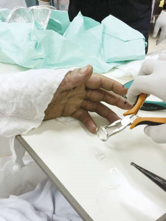 رجال الاطفاء كسروا الخاتم بنجاح في مستشفى مبارك﻿