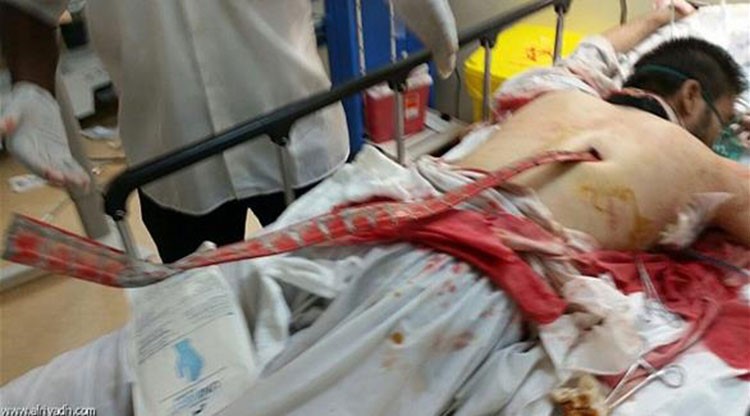صورة: استخراج سيخ حديدي من ظهر مصاب في حادثة الحرم