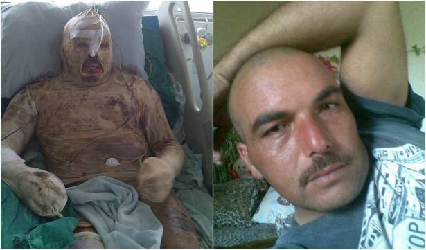 صورة مركبة للمغدور بري الشامي، على اليمين يظهر حيا والى اليسار بعد حادثة الحرق التي لم ينج منها