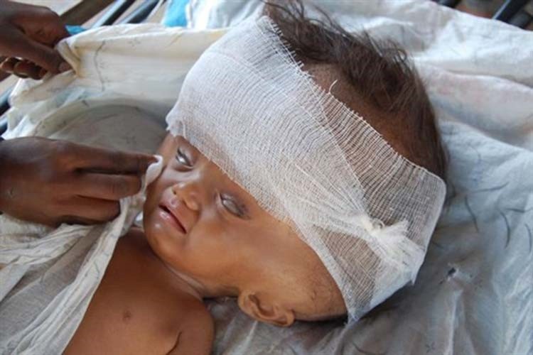 بالصور.. حالة نادرة لطفلة تضاعف حجم رأسها 3 مرات