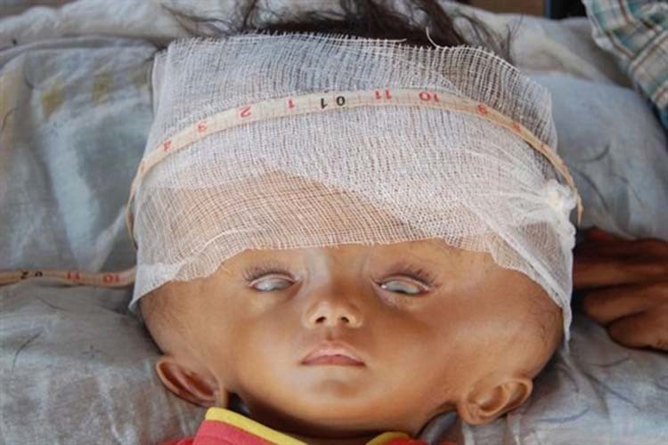 بالصور.. حالة نادرة لطفلة تضاعف حجم رأسها 3 مرات