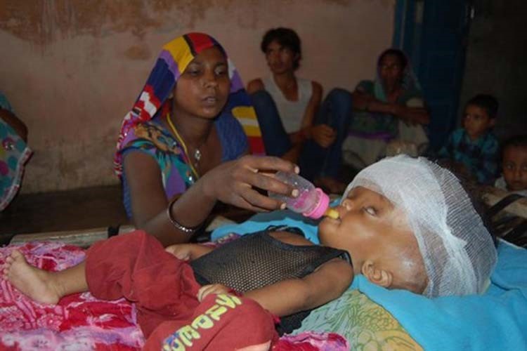 بالصور.. حالة نادرة لطفلة تضاعف حجم رأسها 3 مرات