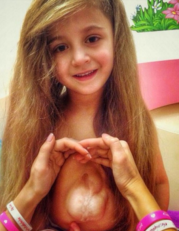 صور مؤثرة لطفلة ينبض قلبها خارج صدرها 