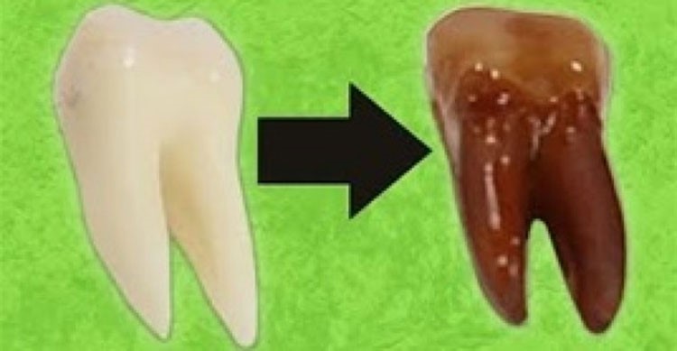  بالفيديو.. هذا ماذا يحدث للأسنان عند وضعها 5 أيام في مشروب غازي