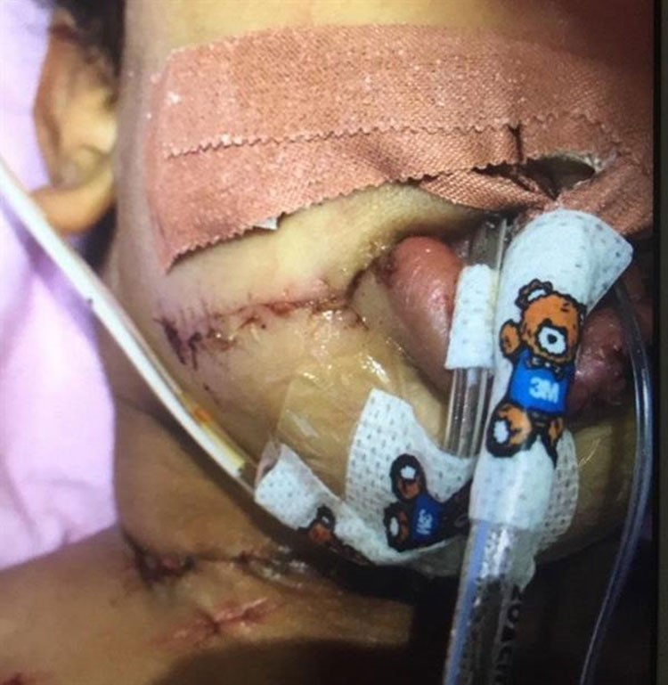 صور مؤلمة.. خادمة في السعودية تتسلل إلى غرفة طفل كفيلها أثناء نومه وتحاول قطع رأسه.. ومعجزة تنقذه
