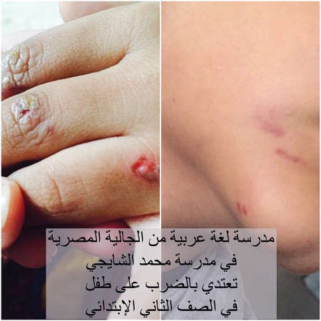 اثار الضرب واضحة على يد التلميذ﻿