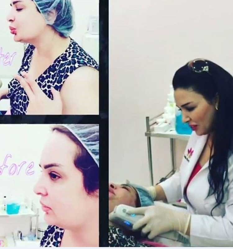 بالصور.. بدرية أحمد تخضع لعملية تجميلية للحصول على "حنج أجمل!"