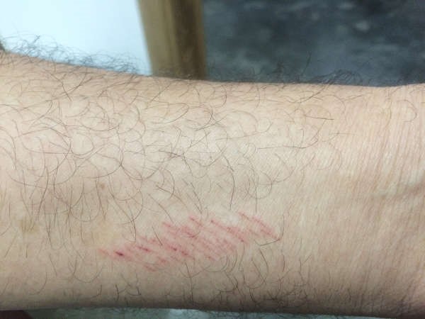 الجرح بعد استخدام blood stoop وقد تماثل للشفاء سريعا