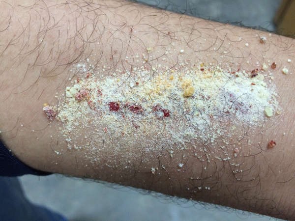 وضع بودرة blood stoop على الجرح يوقف النزيف ويمنع دخول الميكروبات الى الجسم